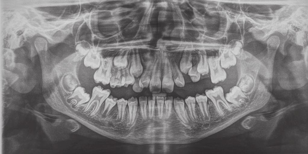 b) A follow-up panoramic radiograph after 6 months: organized bone structure in the region of the cyst, pending eruption for P1, improvement in the position of the permanent canine DISCUSSION: The