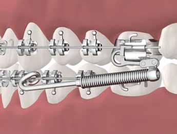 NiTi coil springs are selected to provide the force for space closure due to their ability to provide a constant force on the dentition that does not degrade over time.