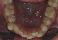 Case 2 Although the patient in Figure 10 has a Class I molar relationship, evaluation of the initial