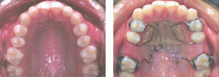 American Journal of Orthodontics and Dentofacial Orthopedics Volume 130, Number 4 Fuziy et al 503 Fig 1.
