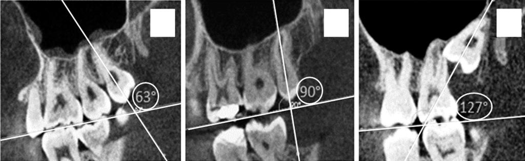Maxillary third molars (white arrows) classified according to the buccolingual position as buccal (C), central (D), or lingual (E). A B C Fig. 2. Sagittal conebeam computed tomography sections.