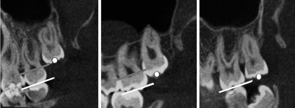 Threedimensional analysis of impacted maxillary third molars: A conebeam computed tomographic study of the position and depth of impaction A B C Fig. 3. Sagittal conebeam computed tomography sections.