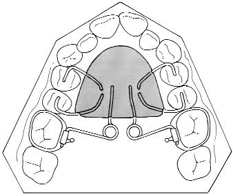 334 Bussick and McNamara American Journal of Orthodontics and Dentofacial Orthopedics March 2000 Fig 1. Typical design of the pendulum appliance of Hilgers.