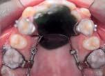 premolars was achieved