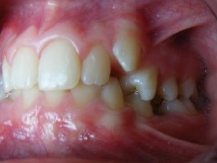 Intraoral aspect- before