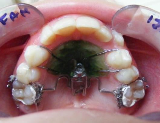 to wear an extraoral appliance: