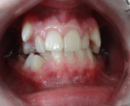 bilaterally followed by a palatal expander and a full fixed appliance