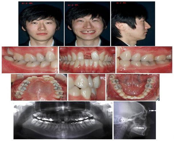 it was possible to move the maxillary central incisor through the midpalatal suture in a 19-year-old woman, but the midpalatal suture was also deviated to the same side of tooth movement.