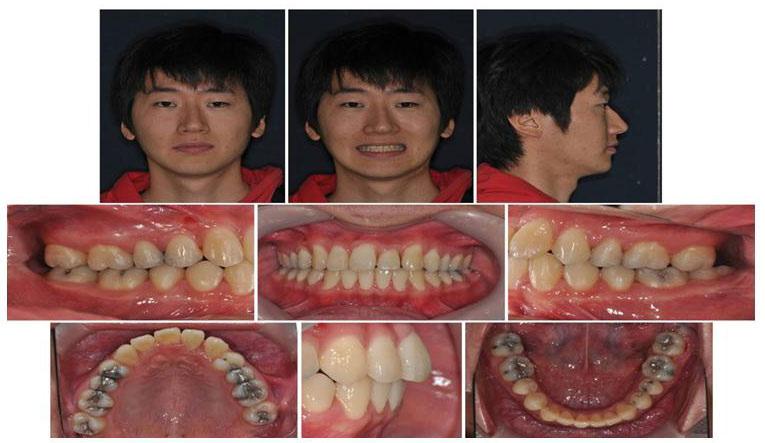 The miniscrews in the right and left side were used for the distalization and mesialization of the maxillary posterior teeth, respectively. (E) Correction of the dental midline and molar relationship.
