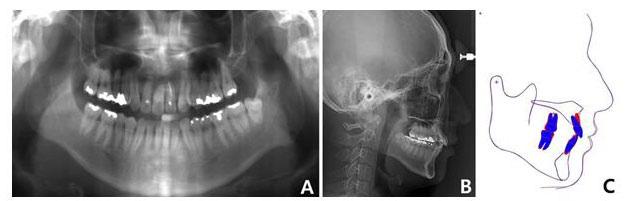 Figure 5. (A) Posttreatment panoramic radiograph. (B) Cephalometric radiographs. (C) Superimposition of the pretreatment (red) and posttreatment (blue) cephalometric tracings. Figure 6.
