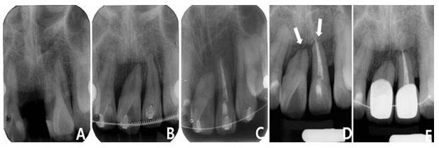Figure 7. Serial periapical radiographs. (A) Pretreatment. (B) Nine months of treatment. (C) 29 months of treatment. The lateral incisor was endodontically treated due to a hypersensitivity.