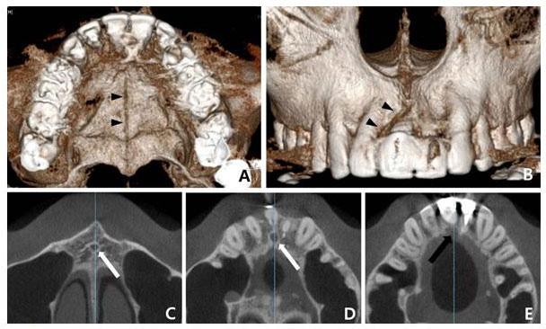 Figure 8. CBCT images at five months of postretention. (A) Horizontal view. (B) Frontal view. The midpalatal suture (arrow head) was not closed, and it was deviated to the right side.