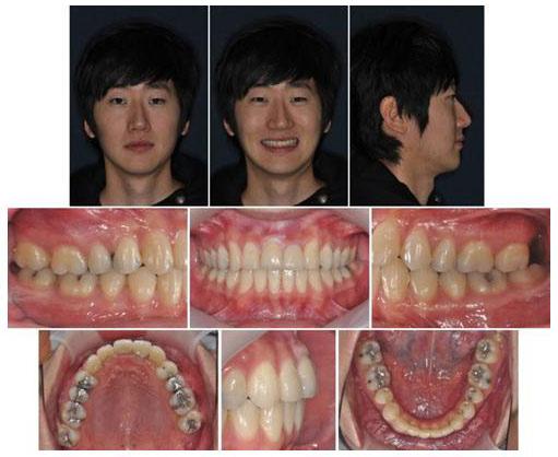 Figure 9. Extraoral and intraoral photographs at five months of postretention.