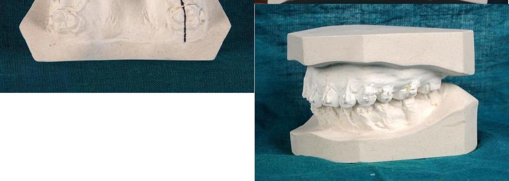 but in this intra-arch mechanics,e-chain crosses over the occlusal surface of maxillary 2 nd molar along with low placed L-loop delivers intrusive force on maxillary 2 nd molar.