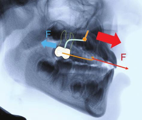 S48 Wilmes et al. Mini-implant Supplement JO September 2014 case report. This also describes the clinical procedures involved with the technique.