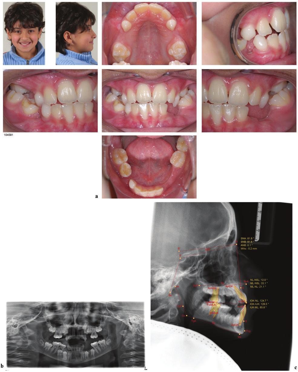 JO September 2014 Mini-implant Supplement Hybrid Hyrax Distalizer S49 Figure 2 (a) 10-year-old male patient with a severe Class III malocclusion, early loss of the