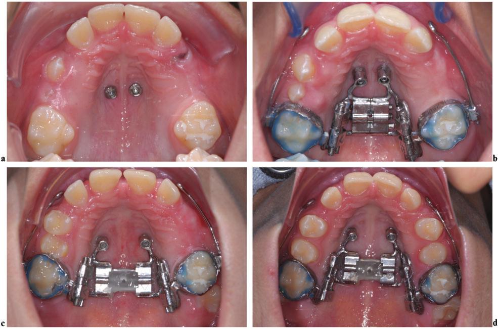 JO September 2014 Mini-implant Supplement Hybrid Hyrax Distalizer S51 Figure 4 (a) Two mini-implants inserted near the third palatal rugae. (b) After installation of the Hybrid Hyrax Distalizer.