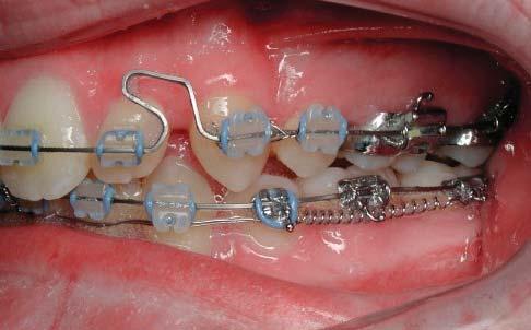 The 20/20 molar in combination with the Roncone J.S.O.P.