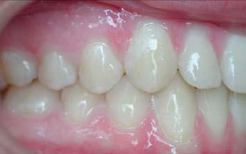 The final touch in arch development is the appearance of the mesial