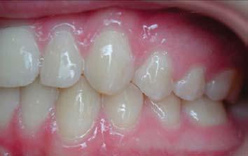 Part of arch and tooth microesthetics is the gradual distal tipping of