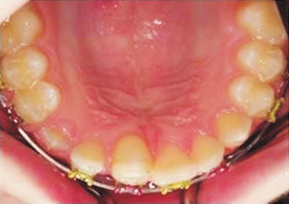 Vishwanath et al utotransplantation: biologic alternative for tooth replacement autotransplanted tooth and the edentulous
