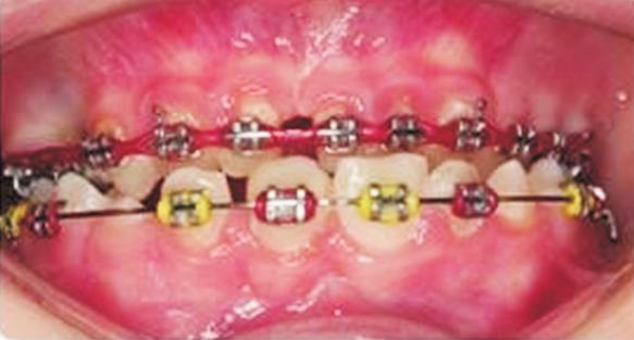Specific orthodontic treatment objectives involved closure of the donor tooth space and movement of the autotransplanted