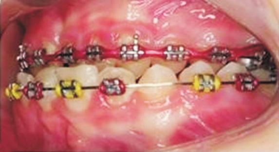 The final plan involved the orthodontic closure of all spaces to eliminate the need for future dental implants, followed by