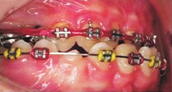 022-inch MTTM prescription metal brackets were bonded on the maxillary and mandibular teeth and initial archwires were placed.