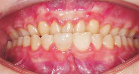 helped in achieving good functional occlusion at the end of the orthodontic treatment (Figure 4).
