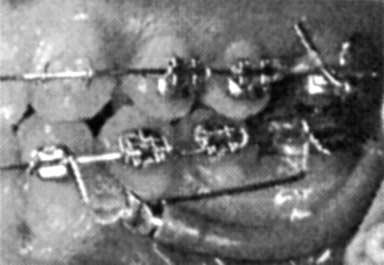 The Herbst produces backward and upward movements of maxillary molars in conjunction with distalcrown tipping.