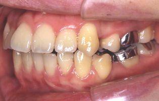Lower Occlusal INTRA-ORAL