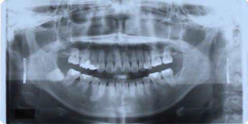 PERIAPICAL OR PANORAMIC RADIOGRAPHS AT COMPLETION