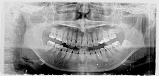 ESLO 26 PERIAPICAL OR PANORAMIC RADIOGRAPHS AT RETENTION /