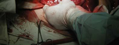Se intervine chirurgical, în mai 2006 prin laparoscopie deschisă, dar, din cauza aderenţelor din etajul supramezocolic, se practică laparotomie subcostală dreaptă.