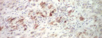 11 Metastază hepatică de cancer mamar Formaţiune nodulară limfocitară intercalată în zona tranziţională, bogată