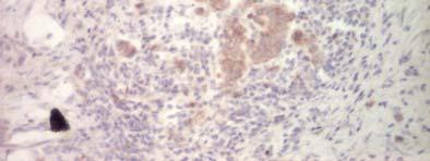 expansiune în ficat a unei formaţiuni metastatice de cancer mamar (marcaj DAB; contracolorare Hematoxilină) Fig.