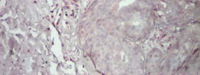15 Cancer mamar tumoră primară Se evidenţiiază relativ numeroase TIL-uri de tip Tc CD8+ (marcaj roz, fucsină),