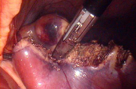 2 Intraoperative view A,B Metastasectomy, using LigaSure C,D