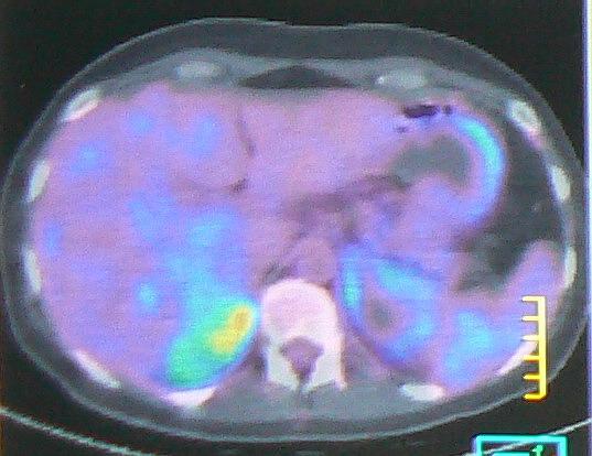7-th segment, small pancreatic tumor (Fig. 4). Fig. 4 PET scan Large adrenal glands with intense absorption of the marker; nodule of 7 cm in 6-th liver segment Fig.