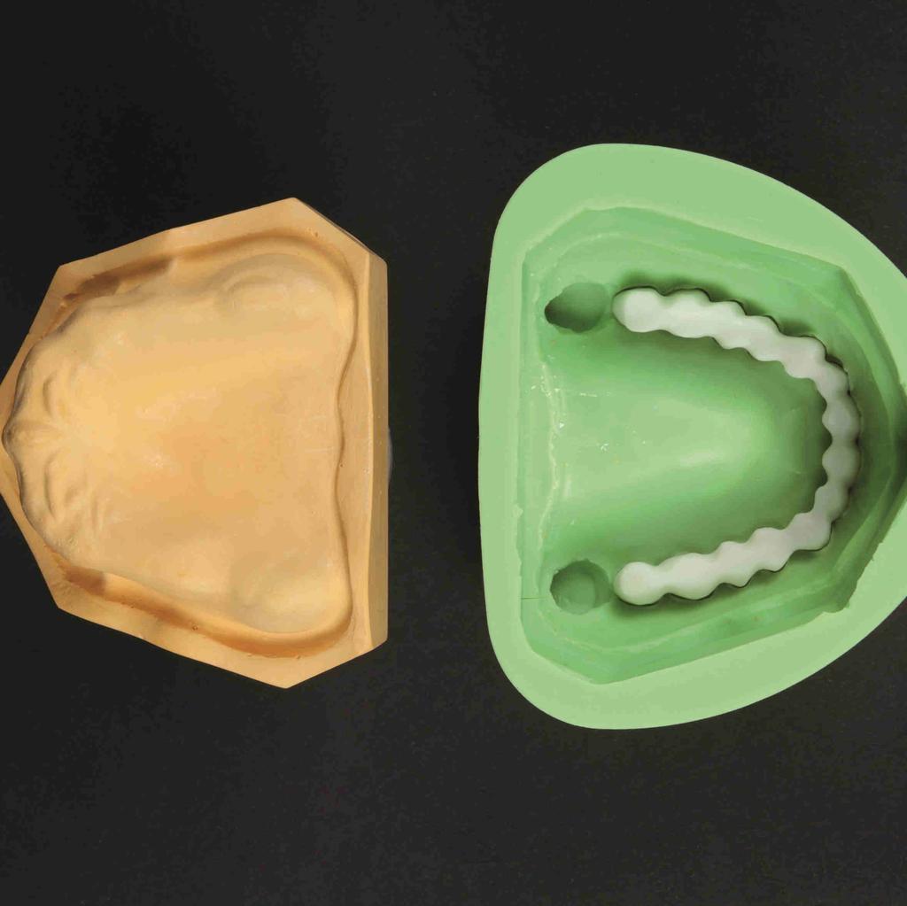 The acrylic mix must contact the surface of the model so that the dental arch acquires the shape of the mucosal situation. 7. Allow the dental arch made of radio-opaque acrylic to cure. 8.