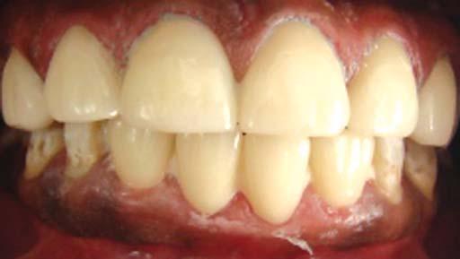 WJD Smile Designing with Ceramic Veneers and Crowns Treatment Plan Orthodontic space closure was refused by the patient due to limited time on hands as he was to be married in 3 weeks.