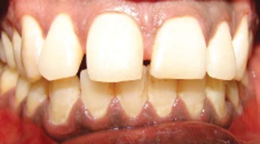 and conservative techniques, such as dental bleaching and restoration with composite or ceramic veneers.