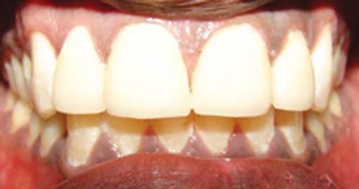 Previous endodontic and restorative treatment of the tooth was found to be inadequate.