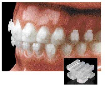 COSMETIC BRACKETS CERAMIC BRACKETS 20/40 ceramic brackets are simply the strongest ceramic bracket on the market.