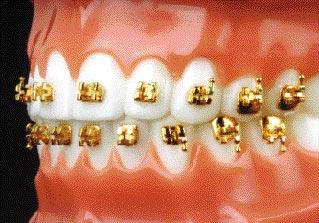 COSMETIC BRACKETS STAINLESS STEEL BRACKETS For patients who prefer true brilliant gold shine, American Orthodontics offers Forever Gold 2.