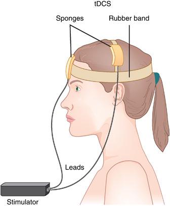 TRANSCRANIAL DIRECT CURRENT STIMULATION (TDCS) It is a non-invasive procedure in which a device sends a small Direct Current (DC) across electrodes in the areas of interest on the scalp to modulate
