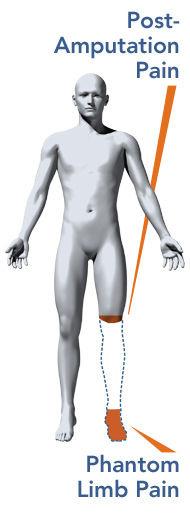 Phantom limb pain Phantom limbs give impression of pressure and pain Even if phantom limb is experienced as spatially detached from the body, it is still felt to belong to the patient.