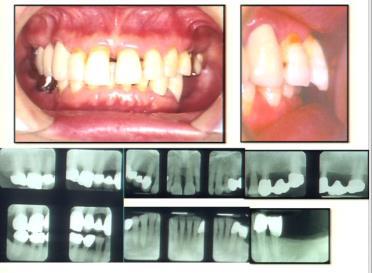 Occlusal force will affect position Summarizing force on teeth Unbalancing in one of the factors mentioned, teeth will move to find a new place Based on severity of pathologic tooth migration