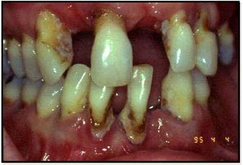 Aggressive Periodontitis Localized (< 30% of sites are involved) Aggressive localized slight periodontitis Aggressive localized moderate periodontitis Aggressive localized severe