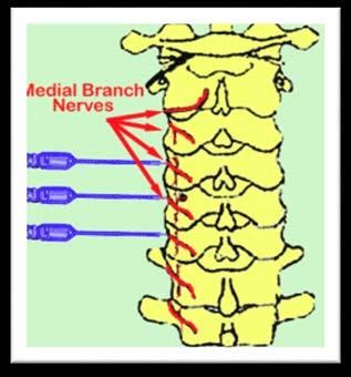 In order to determine whether or not the facet joint are causing your neck pain or your headaches, medial branch nerves could be
